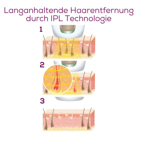 Illustration der langanhaltenden Haarentfernung durch IPL-Technologie in drei Schritten.