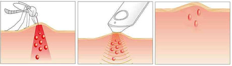 Illustration von Aknebehandlung: Pickel werden mit einem Werkzeug, Laser oder Licht behandelt.